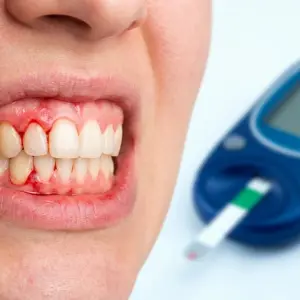 Diabete e gengive: una relazione a doppio senso