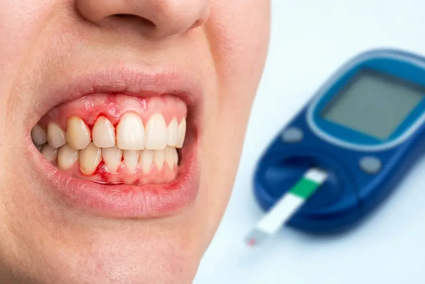 diabete_gengive_relazione_860x575_finale Diabete e gengive: una relazione a doppio senso