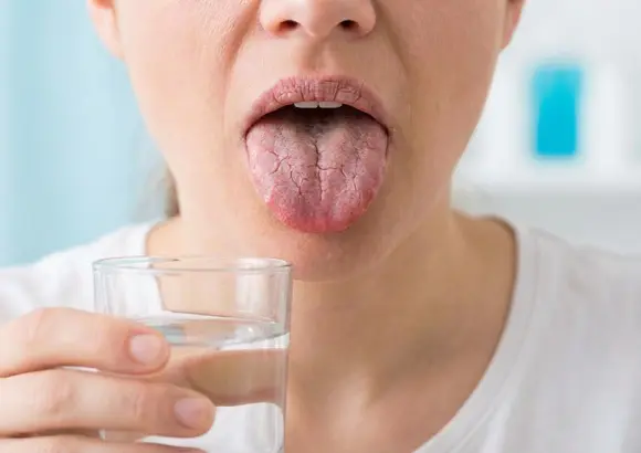 Bocca secca o xerostomia: quando la saliva non basta