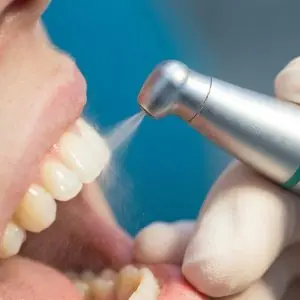 Air polishing ed igiene orale: una pulizia più delicata ed efficace