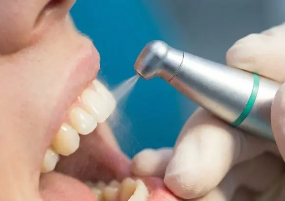 Air polishing ed igiene orale: una pulizia più delicata ed efficace